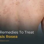 Home Remedies to Treat Pityriasis Rosea: 10 Natural Remedies That Actually Help