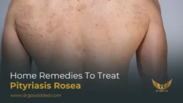 home Remedies to Treat Pityriasis Rosea