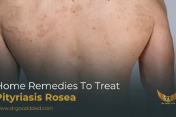 home Remedies to Treat Pityriasis Rosea