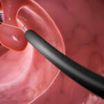 Can Polyps Cause Constipation? Symptoms, Bowel Changes, and When to Worry