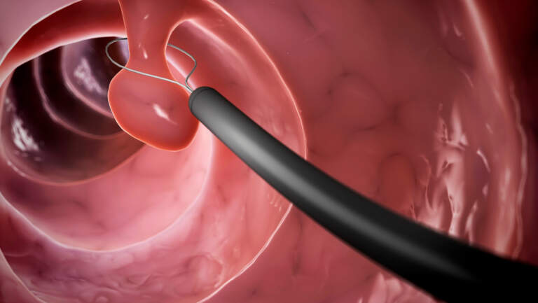 Can Polyps Cause Constipation? Symptoms, Bowel Changes, and When to Worry