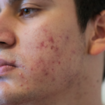 The Complete Guide to Acne