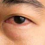 Home Remedy for Conjunctivitis Eyes: Safe Ways to Treat Pink Eye at Home
