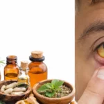 Home Remedies for Jaundice: Safe Supportive Care for Liver Recovery