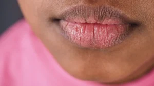 home remedies for dry lips​
