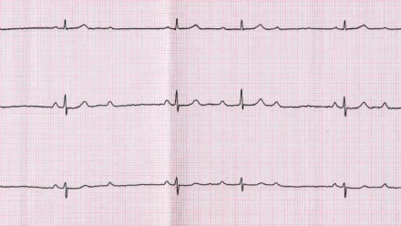 Second-Degree Heart Block: Symptoms, ECG Findings, Causes, and Treatment