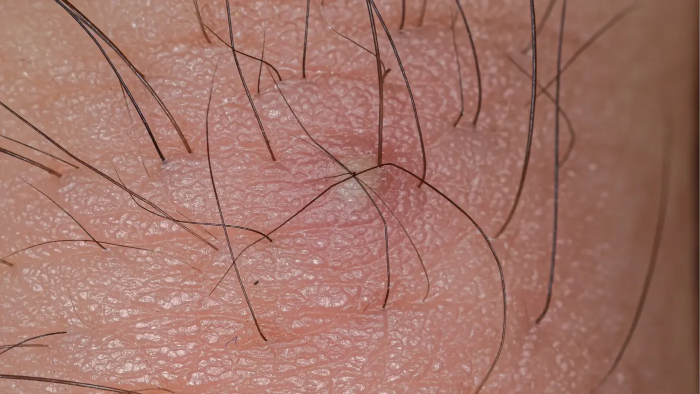 Ingrown Hair on Penis: Causes, Symptoms, and Safe Treatment