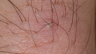 Ingrown Hair on Penis: Causes, Symptoms, and Safe Treatment
