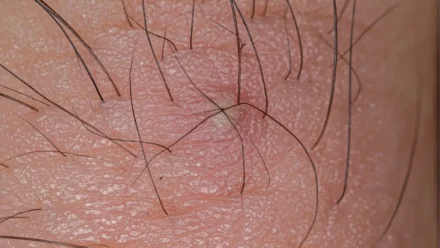 Ingrown Hair on Penis: Causes, Symptoms, and Safe Treatment
