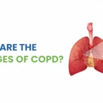 What Are the 4 Stages of COPD? Symptoms, Progression & Treatment