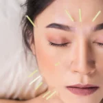 Acupuncture for Allergies: Does It Really Work for Relief?