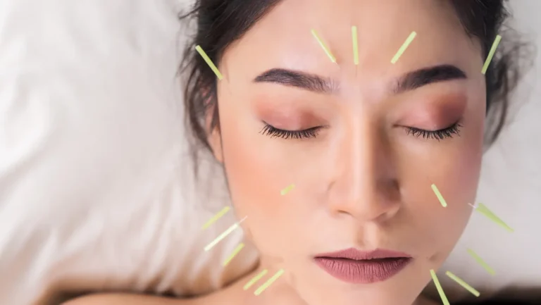 acupuncture for allergies