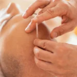 Acupuncture for Hair Loss: Does It Work?