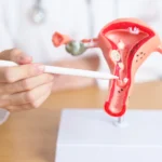 Can Ovarian Cysts Cause Infertility?
