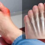 Early Stage Gout Symptoms: First Signs You Should Not Ignore