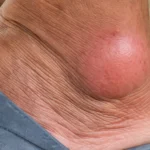 Gout in Ankle: Causes, Symptoms, and Fast Relief for Ankle Gout Pain