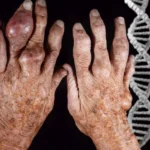 Is Gout Hereditary? Genetics, Risk Factors, and What It Means for You