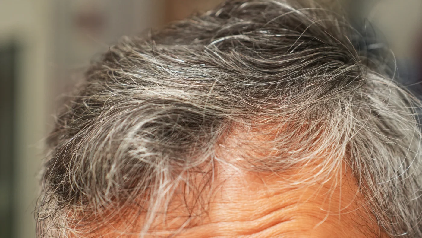 Can Stress Cause Gray Hair? Science, Causes, and Prevention