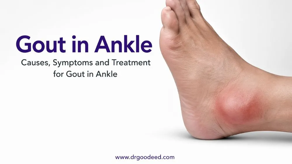 What Causes Gout in the Ankle