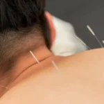 Dry Needling vs Acupuncture: Key Differences, Benefits & Which Works Better