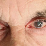 What Is an Eye Stroke? Causes, Symptoms, and Vision Loss Explained