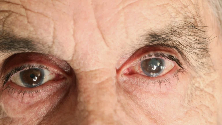 What Is an Eye Stroke
