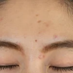How to Get Rid of Forehead Acne: Causes, Treatments, and Prevention Tips