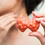 Hyperthyroidism