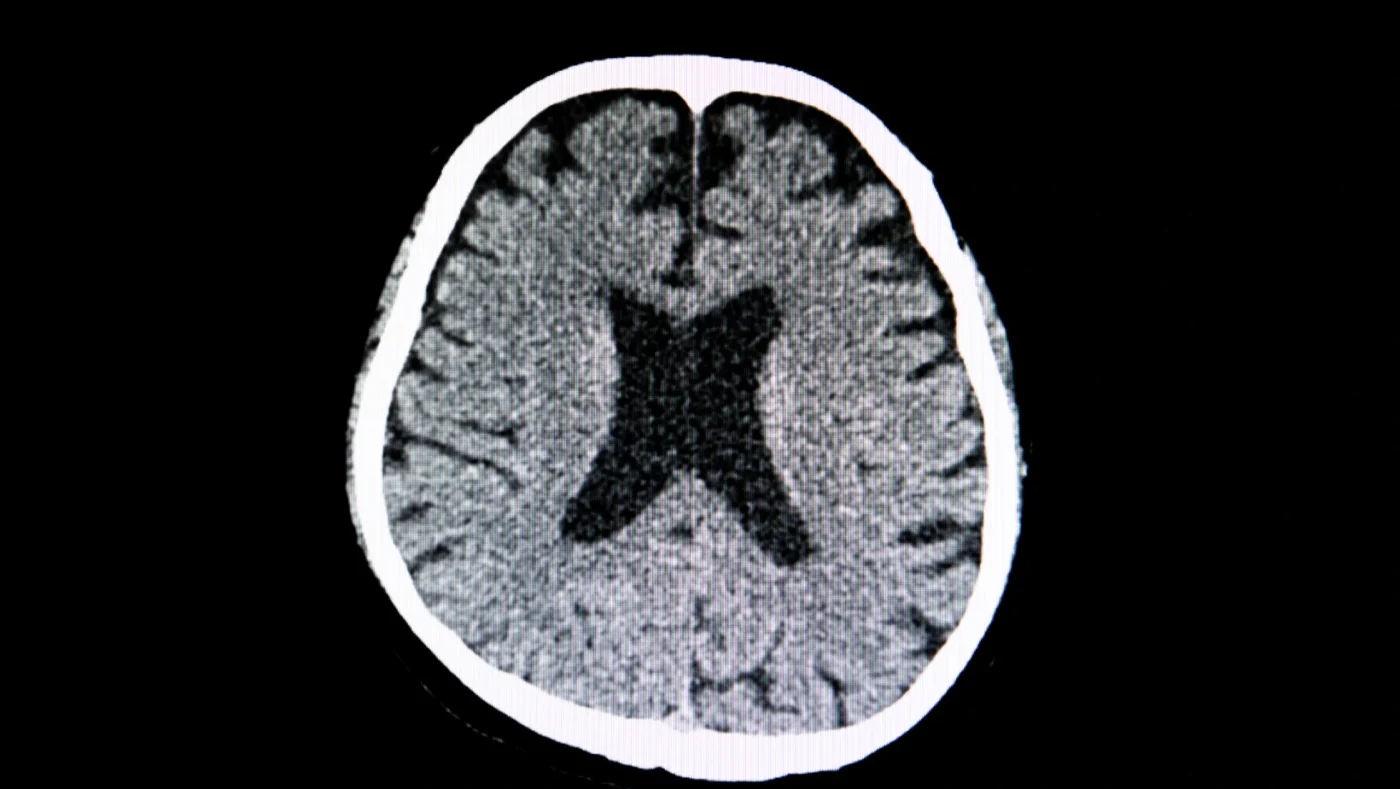 What to Know About a Lacunar Stroke: Causes, Symptoms, and Recovery
