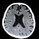What to Know About a Lacunar Stroke: Causes, Symptoms, and Recovery