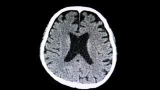 What to Know About a Lacunar Stroke: Causes, Symptoms, and Recovery