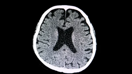 What to Know About a Lacunar Stroke: Causes, Symptoms, and Recovery