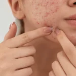 Types of Acne Scars: How to Identify Them and Best Treatment Options