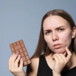 Does Chocolate Cause Acne? Understanding the Link Between Diet and Breakouts