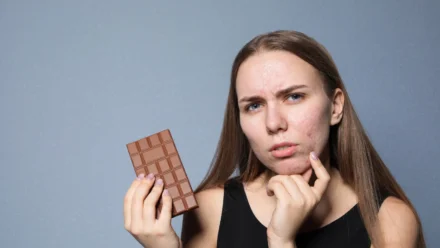 Does Chocolate Cause Acne? Understanding the Link Between Diet and Breakouts