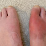 Gout