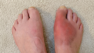 Gout
