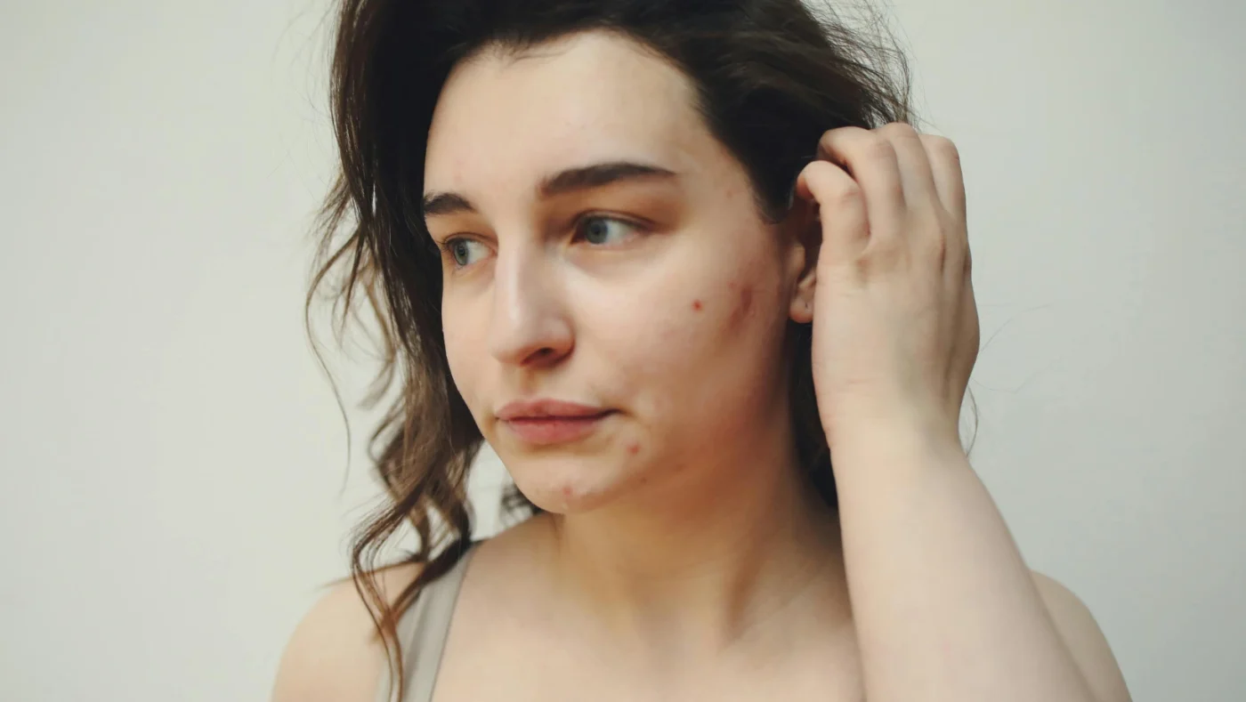 Does Smoking Weed Cause Acne? Cannabis, Skin Health, and Breakouts Explained