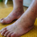Can Diabetic Neuropathy Be Reversed? Symptoms, Recovery, and Treatment