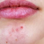 Acne Around the Mouth: Causes, Treatments, and How to Prevent Breakouts