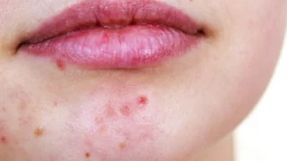 Acne Around the Mouth: Causes, Treatments, and How to Prevent Breakouts