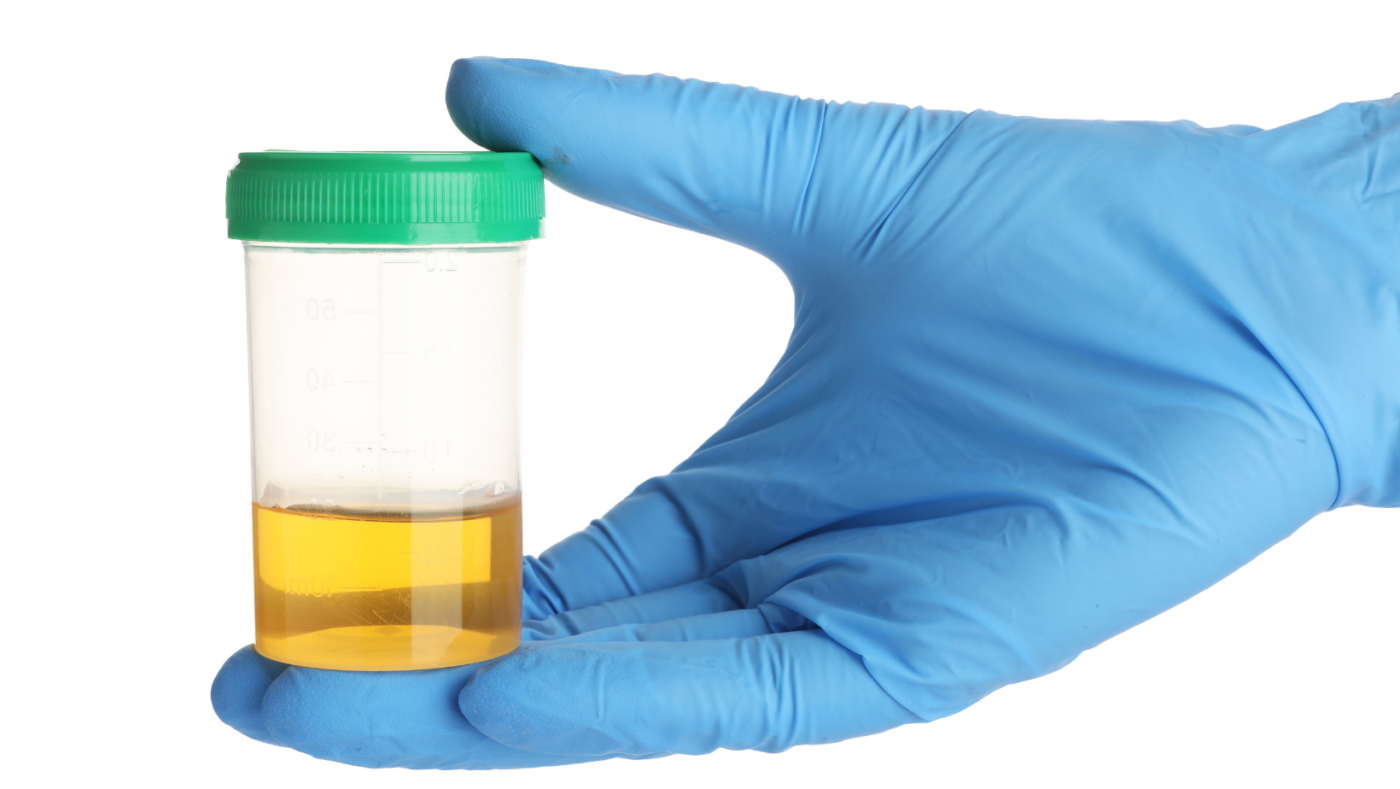 Pee Appears Cloudy: Causes, Symptoms, and When to Worry