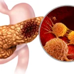 Signs of Pancreatic Cancer: Early Warning Symptoms You Should Not Ignore