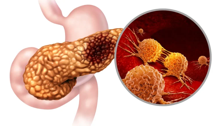 Signs of Pancreatic Cancer: Early Warning Symptoms You Should Not Ignore 33 Signs of Pancreatic Cancer