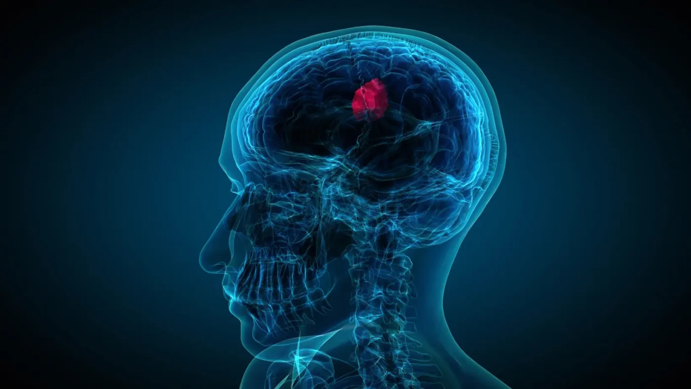 Early Signs of Brain Tumor: Symptoms, Warning Signs, and When to Seek Medical Care