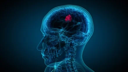 Early Signs of Brain Tumor: Symptoms, Warning Signs, and When to Seek Medical Care