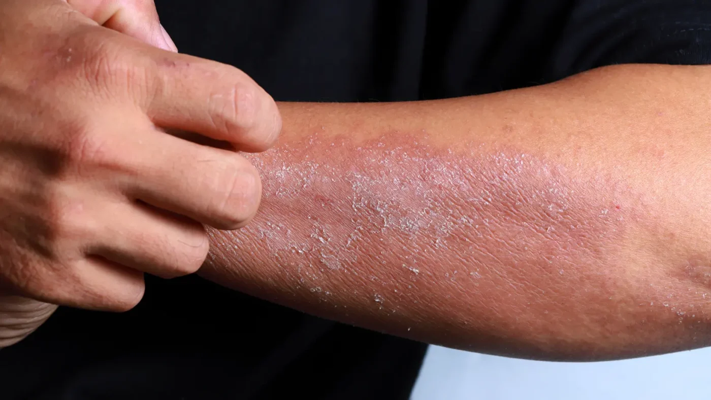 Chinese Herb for Eczema: Traditional Remedies, Skin Support, and What to Know