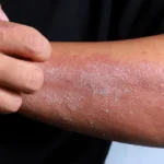 Chinese Herb for Eczema: Traditional Remedies, Skin Support, and What to Know