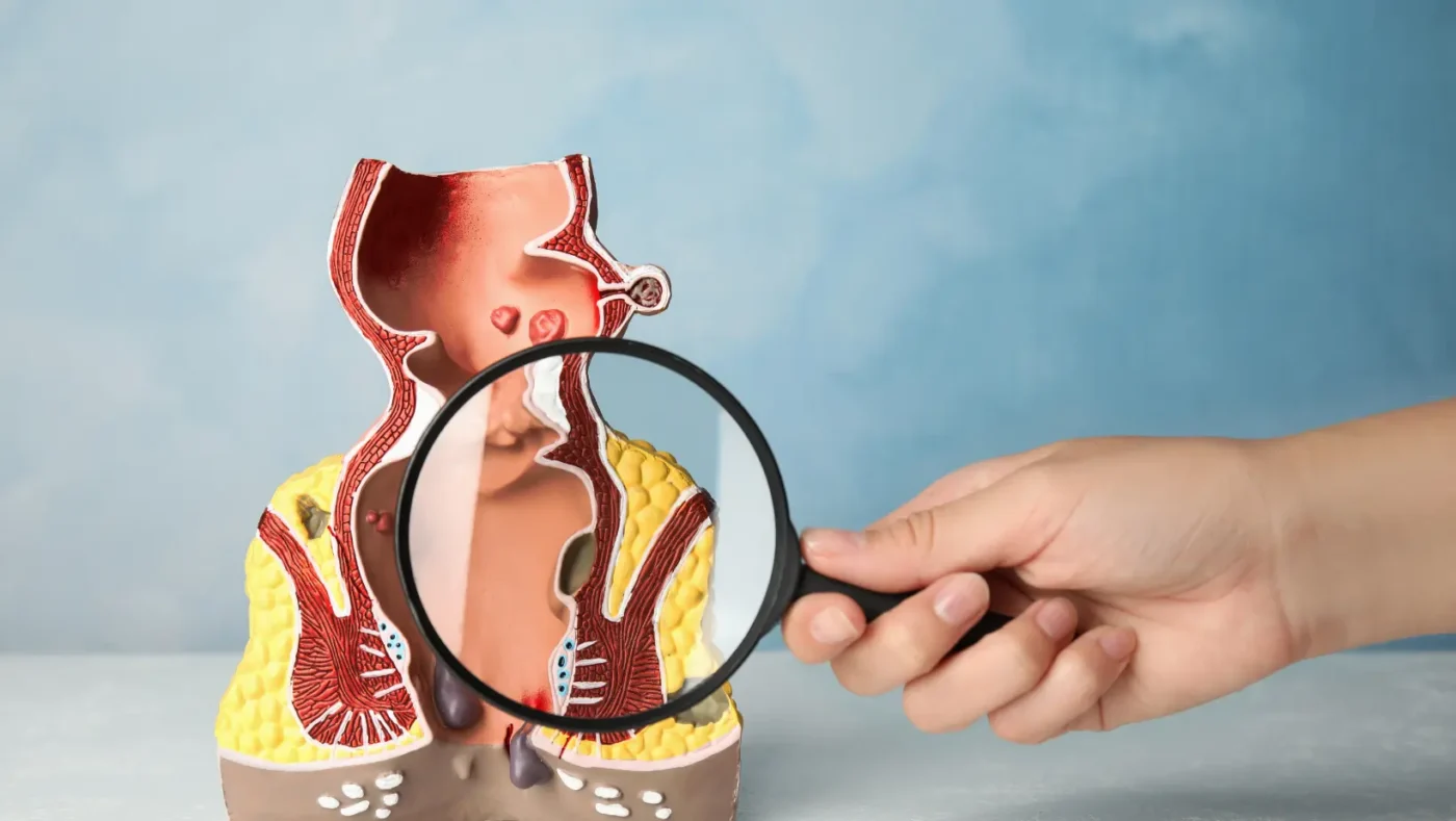 Can Hemorrhoids Cause Cancer? Understanding Hemorrhoids, Rectal Bleeding, and Cancer Risk 5 Can Hemorrhoids Cause Cancer? Understanding Hemorrhoids, Rectal Bleeding, and Cancer Risk