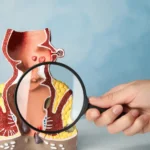 Can Hemorrhoids Cause Cancer? Understanding Hemorrhoids, Rectal Bleeding, and Cancer Risk